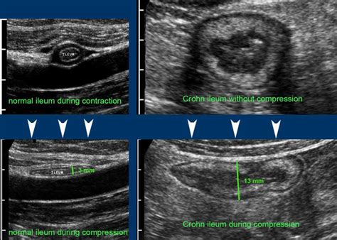 measurement of small intestine thickness|The Radiology Assistant : CT.